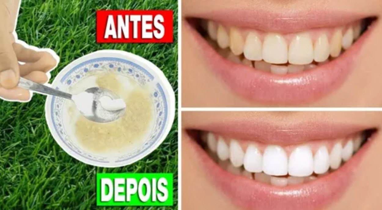 Remédio Caseiro Para Clarear Os Dentes - RETOEDU