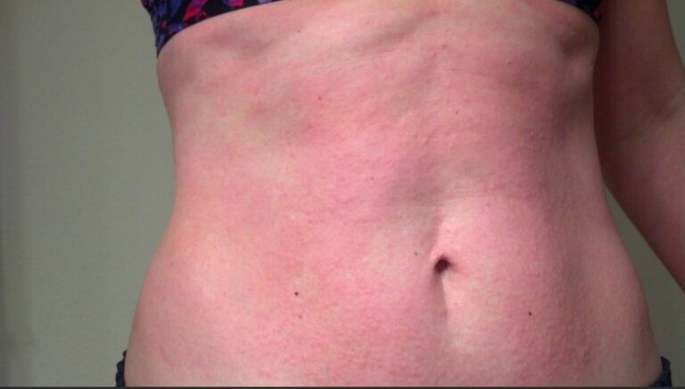 erva para alergia na pele