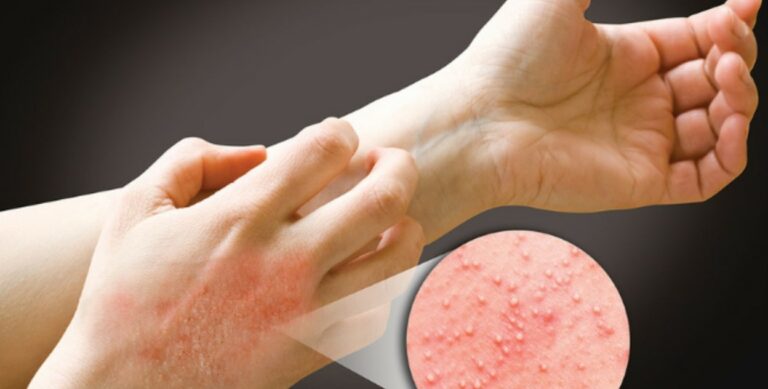 erva para alergia na pele