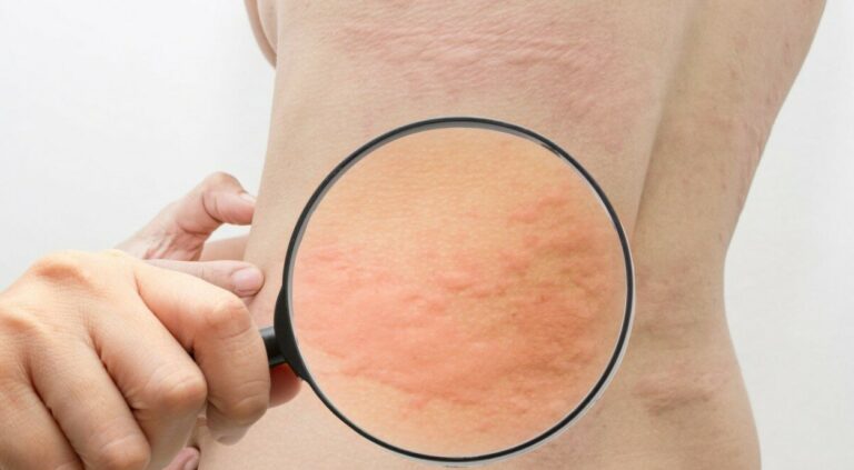 erva para alergia na pele