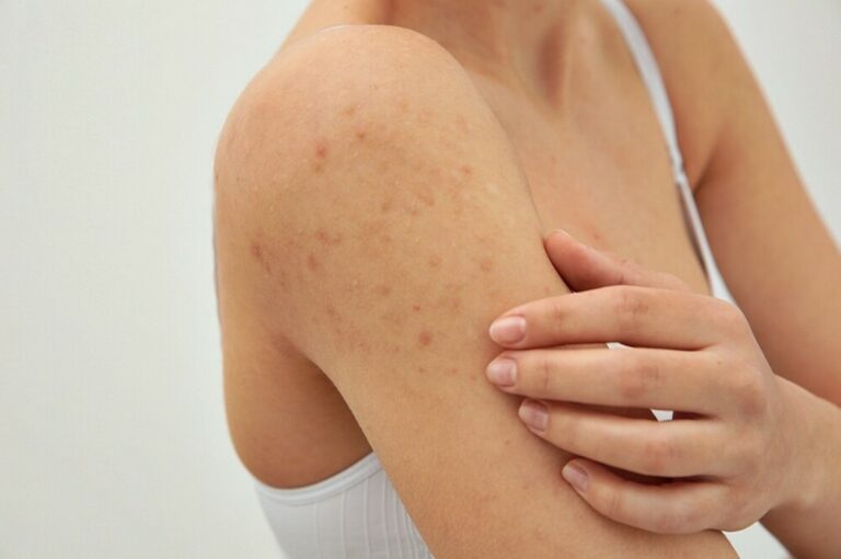 erva para tirar mancha da pele