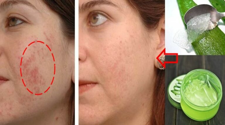 erva para tirar mancha da pele